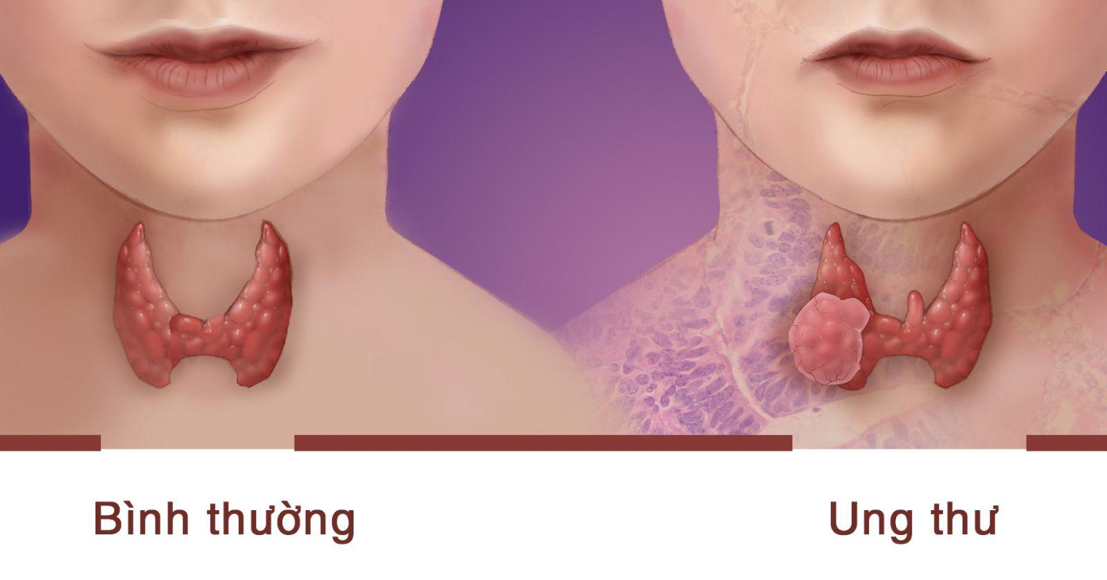 ĐIỀU TRỊ UNG THƯ TUYẾN GIÁP DẠNG NHÚ
