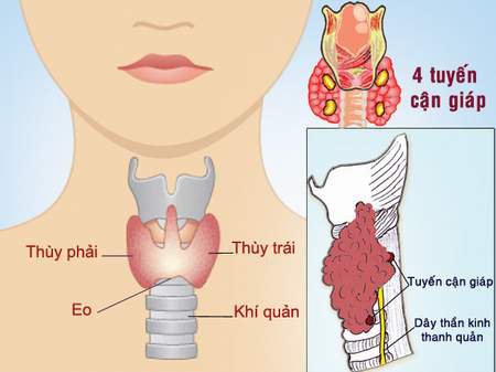 BIẾN CHỨNG CỦA PHẪU THUẬT TUYẾN GIÁP