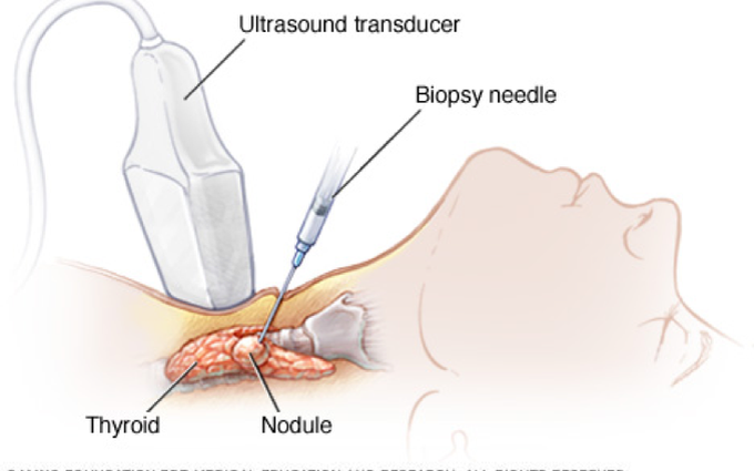 ĐIỀU TRỊ HỘI CHỨNG CƯỜNG GIÁP