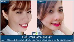 PHẪU THUẬT HÀM HÔ