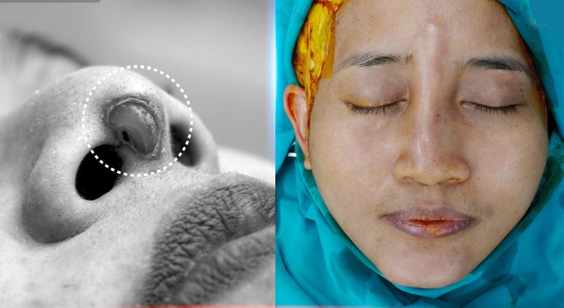 NÂNG MŨI HỎNG - BIỆN PHÁP KHẮC PHỤC