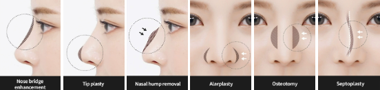 Các thủ thuật cải thiện khuyết điểm mũi
