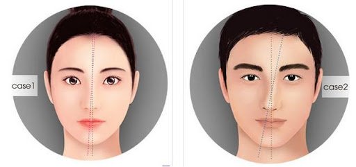Sống mũi lệch sau khi sửa mũi