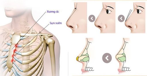 Lấy sườn sụn qua vết rạch 2 - 3 cm dưới ngực