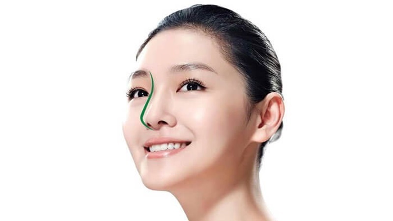 Có nên sửa mũi hay không?