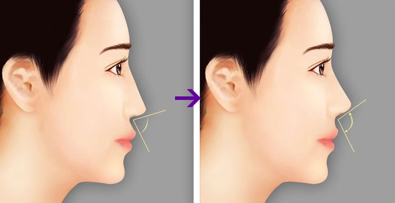Công nghệ nâng mũi Hàn Quốc - xu hướng làm đẹp hiện nay