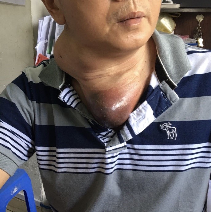 ung thư tuyến giáp