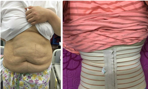 Trải nghiệm cắt bỏ 4 kg mỡ bụng của cô gái nặng 127 kg