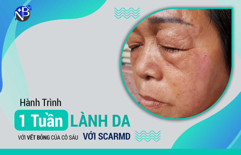 HÀNH TRÌNH PHÒNG SẸO VÀ TRỊ SẸO CỦA CÔ SÁU
