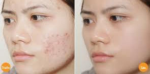 TREATMENT AFTER ACNE BY AQUA MESODERM METHOD