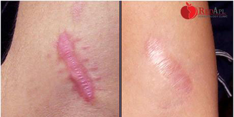 Treatment of keloid scars