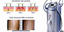 TRIỆT LÔNG VĨNH VIỄN